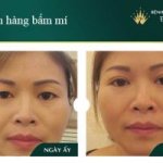 6 Cách làm nhanh hết sưng khi nhấn mí Đơn Giản – Hiệu Quả tại nhà
