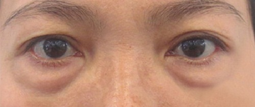 Bọng mỡ mắt là gì và đẹp hay xấu? Tìm hiểu ngay cách khắc phục hiệu quả