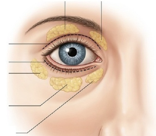 Công nghệ cấy mỡ hiện đại cho đôi mắt trẻ hóa toàn diện