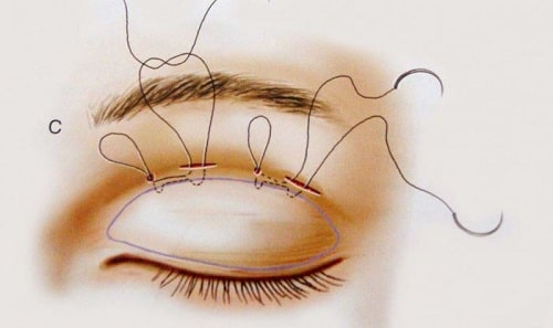 Bạn đã thực sự hiểu về phương pháp phẫu thuật thẩm mỹ mắt?