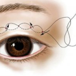 Bấm mí mắt – Công nghệ an toàn cho đôi mắt đạt vẻ đẹp hoàn mỹ