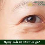 Bọng mắt bị nhăn – Nguyên nhân & cách trị vết nhăn ở bọng mắt hiệu quả