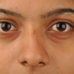 Nguyên nhân và cách chữa bọng mắt hiệu quả tại nhà