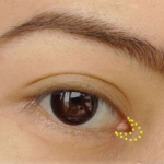 Mở góc mắt bao lâu thì lành? 3 Yếu tố giúp mắt nhanh hồi phục