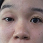 Phụ nữ mắt to mắt nhỏ là gì? Nguyên nhân & 2 cách khắc phục hiệu quả