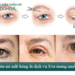 Sửa mí mắt phẫu thuật hỏng An Toàn – Hiệu Quả để mắt đẹp trở lại