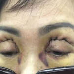 Tác hại của cắt mí mắt NGHIÊM TRỌNG đến từ việc thiếu hiểu biết