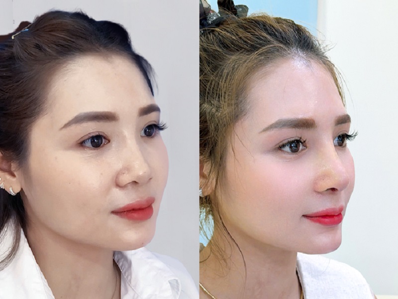 Khách hàng sau khi thực hiện nâng mũi tại Kangnam