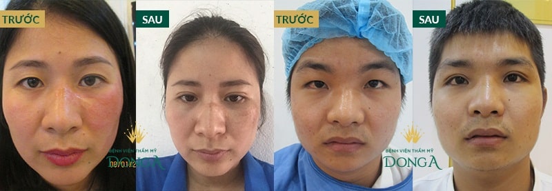 Hình ảnh khách hàng trước - sau thẩm mỹ mắt tại Bệnh viện thẩm mỹ Đông Á