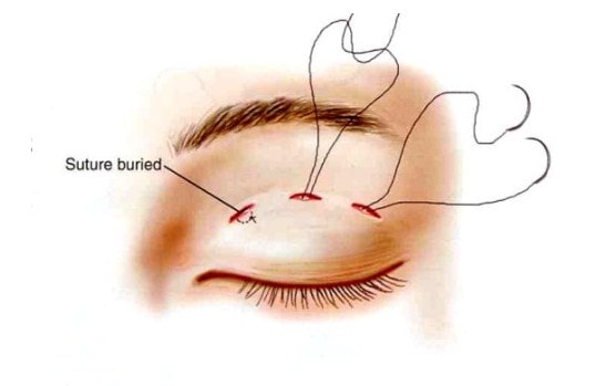 Nhấn mí mắt giá rẻ có đau không Bam-mi-bao-nhieu-tien-min