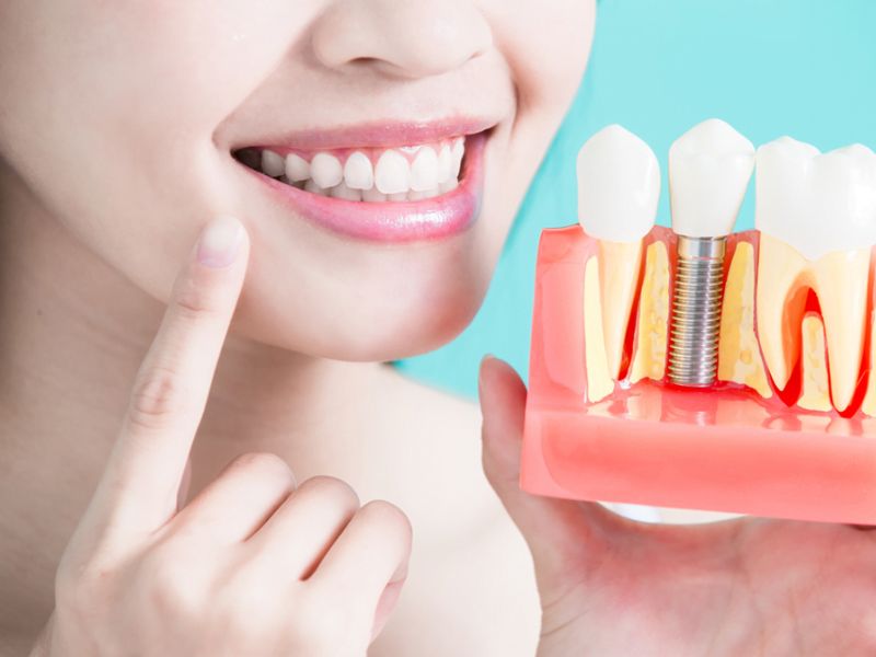Trụ Implant 