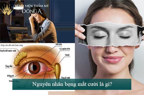 Bọng mắt cười là gì? Phẫu thuật bọng mắt cười giá bao nhiêu? 2