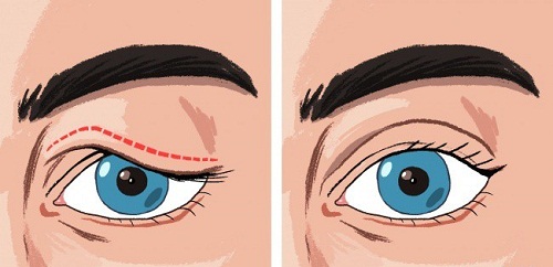 Bọng mắt trên là gì? Nguyên nhân & cách trị bọng mắt trên hiệu quả nhất 5