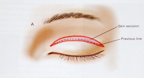 2 Cách chữa mắt một mí Dứt Điểm giúp mắt to đẹp hài hòa sau 45p 6