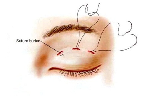 2 Cách chữa mắt một mí Dứt Điểm giúp mắt to đẹp hài hòa sau 45p 3