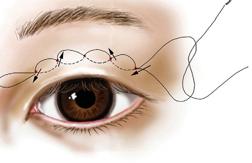 Chuyên gia tư vấn: Cắt chỉ mí mắt có đau không & thời gian hợp lý cắt chỉ 2