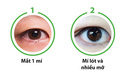 Cắt mắt to tròn chỉ sau 60p với công nghệ độc quyền Eye Lift 7