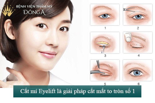 Cắt mắt to tròn chỉ sau 60p với công nghệ độc quyền Eye Lift 9