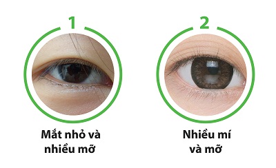 Cắt mắt to tròn chỉ sau 60p với công nghệ độc quyền Eye Lift 8