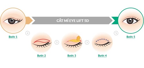 Cắt mắt to tròn chỉ sau 60p với công nghệ độc quyền Eye Lift 10