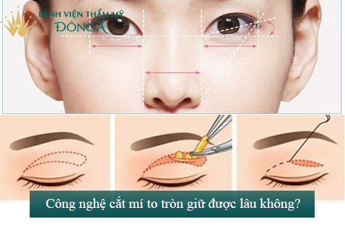 Cắt mắt to tròn chỉ sau 60p với công nghệ độc quyền Eye Lift 11