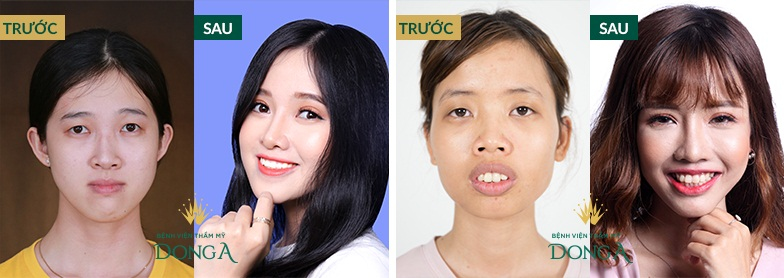Hình ảnh khách hàng trước - sau thẩm mỹ mắt tại Bệnh viện thẩm mỹ Đông Á