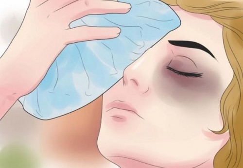 6 Cách giảm sưng sau khi cắt mí mắt hiệu quả cho mắt mau lành Ko đau 2