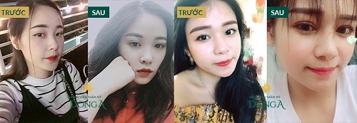 GIẬT MÌNH trước những hậu quả của nhấn mí đến từ việc thiếu hiểu biết 8