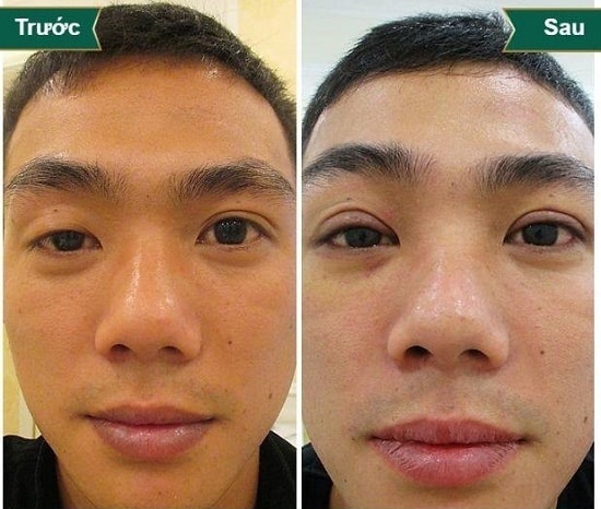 Hình ảnh cắt mí mắt sau 1 tuần, 1 tháng, 2 tháng sẽ thay đổi như thế nào? 3