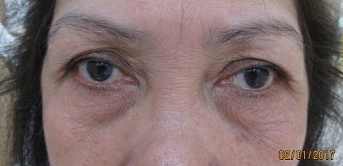 Mắt chảy xệ - 5 Nguyên nhân & 2 Cách khắc phục mắt xệ AN TOÀN 6