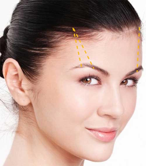 Nâng/treo cung chân mày giá bao nhiêu tiền để An Toàn – KO lộ Sẹo