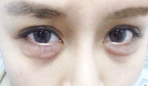 5 Nguyên nhân gây bọng mắt & Cách khắc phục hiệu quả An Toàn 1