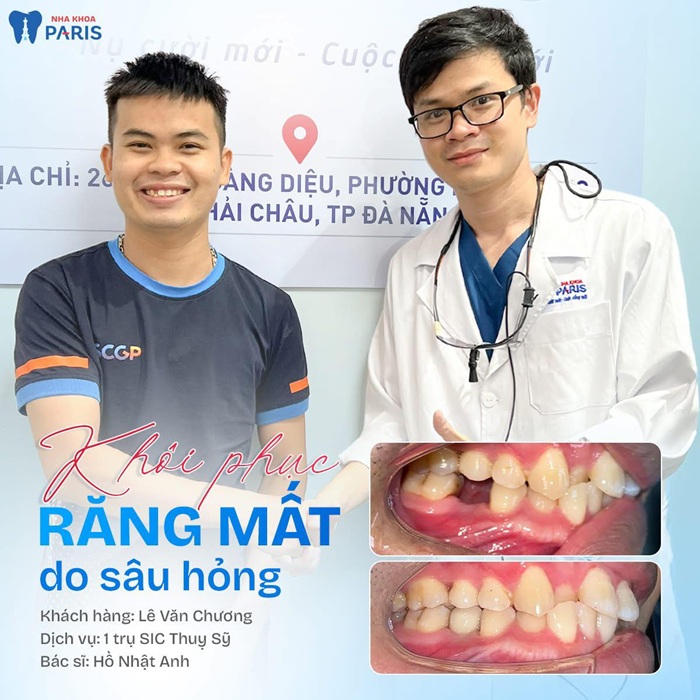 Trồng răng Implant an toàn, cải thiện ăn nhai khi răng mất
