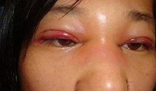 Cùng chuyên gia tìm hiểu vì sao nhấn mí mắt bị nhiễm trùng?