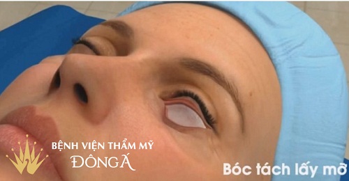 Phẫu thuật cắt bọng mắt An Toàn cho mắt TƯƠI TRẺ lấy lại Thanh Xuân 9