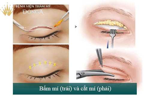 Phẫu thuật mắt hai mí - An toàn - Mắt to đẹp - Tươi trẻ 9