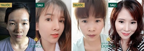 Phẫu thuật mắt to tròn - Khắc phục mọi khuyết điểm của mắt 6