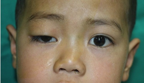 Sụp mí mắt ở trẻ em - Nguyên nhân & Cách khắc phục Hiệu Quả nhất 1