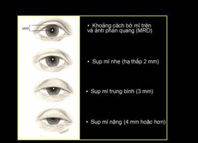 Sụp mí mắt là gì? Nguyên nhân & cách chữa mắt bị sụp mí Hiệu Quả 2