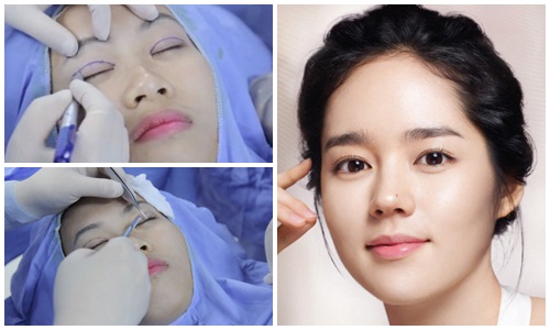 Phẫu thuật thẩm mỹ mắt đẹp – KHẮC PHỤC mọi nhược điểm của mắt