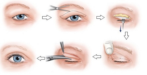 Triệu chứng sụp mí mắt và 2 cách khắc phục hiệu quả theo từng mức độ 5